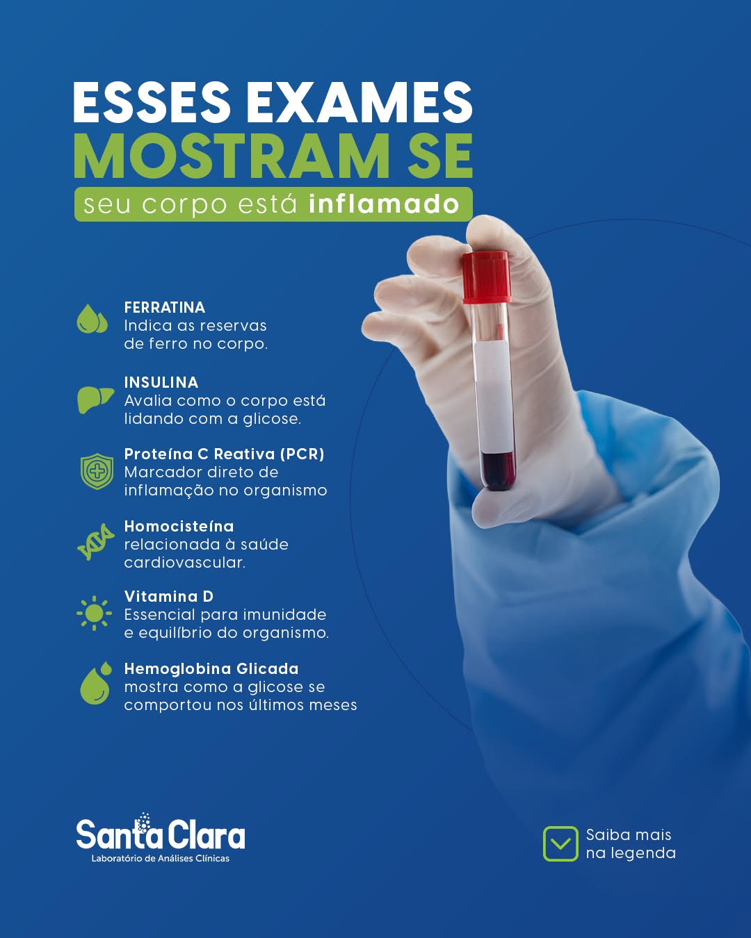 🧪 Seu corpo pode estar inflamado… e os exames mostram isso com clareza.

Alguns exames laboratoriais ajudam a identificar processos inflamatórios e alterações importantes no organismo. Entenda o papel de cada um:
🔴 Ferritina
Indica as reservas de ferro no corpo.
• Baixa: pode causar cansaço, queda de cabelo e anemia
• Alta: pode estar associada a inflamação ou sobrecarga de ferro
💉 Insulina
Avalia como o corpo está lidando com a glicose.
• Elevada: pode indicar resistência à insulina e inflamação silenciosa
📊 Proteína C Reativa (PCR)
Marcador direto de inflamação no organismo.
• Quanto maior, maior a atividade inflamatória
🍬 Hemoglobina glicada
Mostra como a glicose se comportou nos últimos meses
• Níveis elevados indicam risco para diabetes e processos inflamatórios
☀️ Vitamina D
Essencial para imunidade e equilíbrio do organismo
• Baixa: pode estar relacionada a inflamação e baixa defesa do corpo
🧠 Vitamina B12
Importante para energia, cognição e sistema nervoso
• Baixa: pode causar cansaço, fraqueza e alterações neurológicas
❤️ Homocisteína
Relacionada à saúde cardiovascular
• Níveis elevados aumentam o risco de inflamação e problemas no coração
🧬 Gama GT
Avalia a saúde do fígado
• Alterada: pode indicar inflamação hepática ou estresse oxidativo
🔬 Conte com o Santa Clara para realizar seus exames com precisão e segurança.